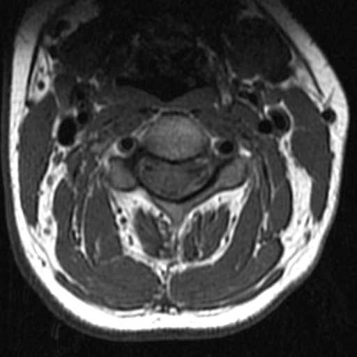 File:Bilateral tortuous vertebral arteries (Radiopaedia 19070-19039 Axial T2 16).jpg