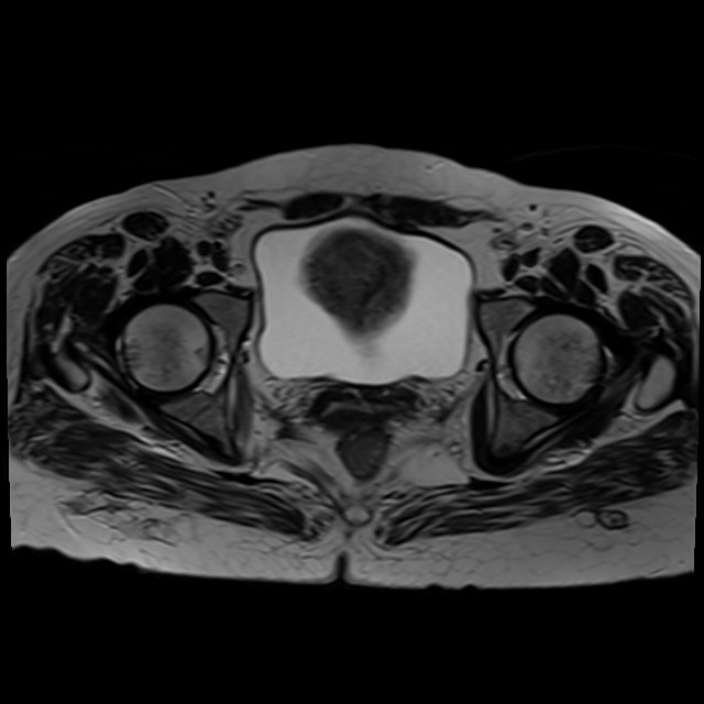 Bilateral tubo-ovarian abscesses (Radiopaedia 58635-65829 Axial T2 34).jpg