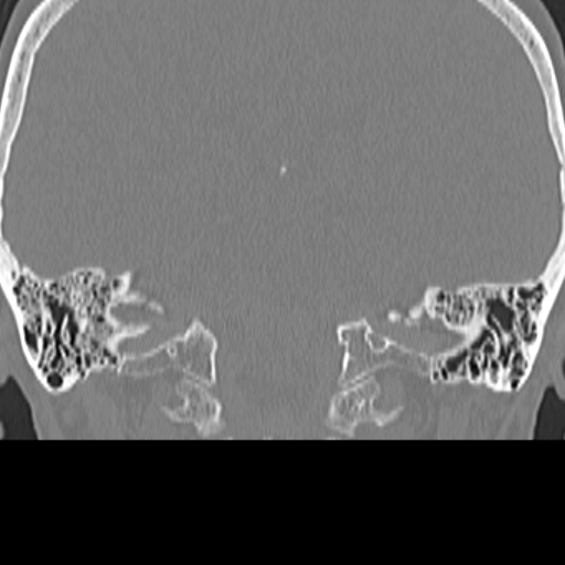 File:Bilateral tympanoplasty (Radiopaedia 16947-16664 Coronal bone window 25).jpg
