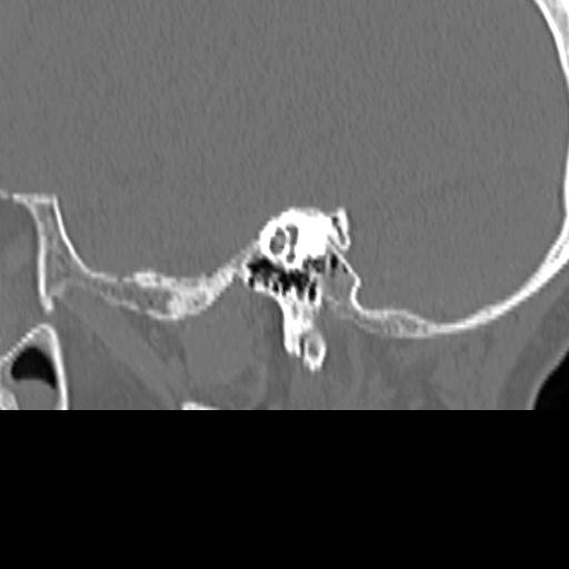 File:Bilateral tympanoplasty (Radiopaedia 16947-16664 Sagittal bone window 38).jpg