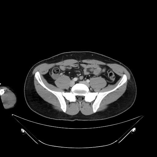 Bile leak from liver traumatic laceration (Radiopaedia 63463-72078 A 56).jpg