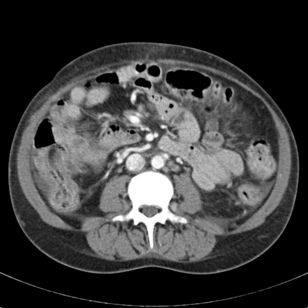 Biliary necrosis - liver transplant (Radiopaedia 21876-21846 B 40).jpg