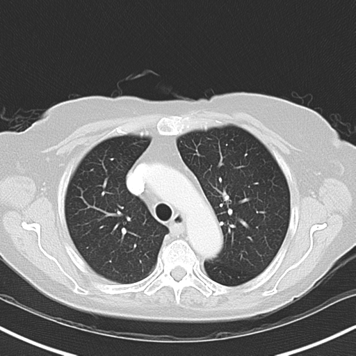 File:Bladder and bowel cancers (Radiopaedia 37688-39592 Axial lung window 16).png