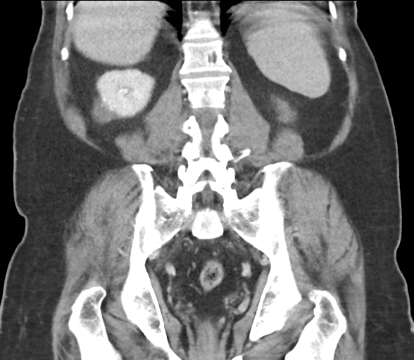 Bladder papillary urothelial carcinoma (Radiopaedia 48119-52951 C 48).png