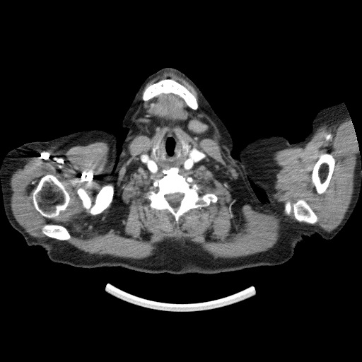 Bladder tumor detected on trauma CT (Radiopaedia 51809-57609 A 5).jpg