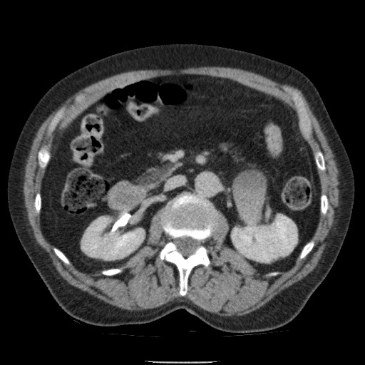 Bladder tumor detected on trauma CT (Radiopaedia 51809-57609 C 54).jpg