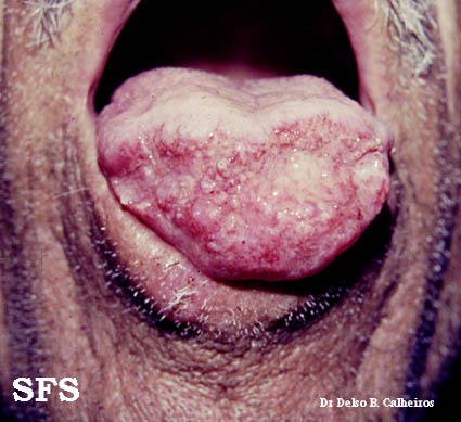 Blastomycosis South American (Dermatology Atlas 1).jpg