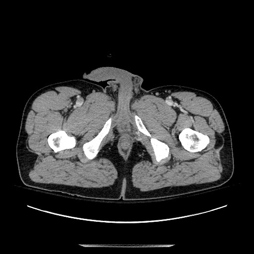 Blunt abdominal trauma with solid organ and musculoskelatal injury with active extravasation (Radiopaedia 68364-77895 A 170).jpg