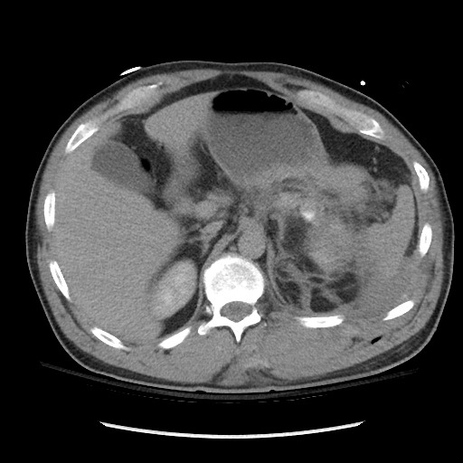 Blunt abdominal trauma with solid organ and musculoskelatal injury with active extravasation (Radiopaedia 68364-77895 Axial C+ delayed 37).jpg