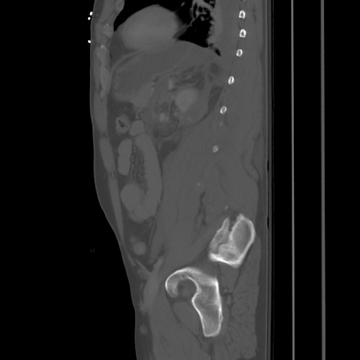 Blunt abdominal trauma with solid organ and musculoskelatal injury with active extravasation (Radiopaedia 68364-77895 Sagittal bone window 73).jpg
