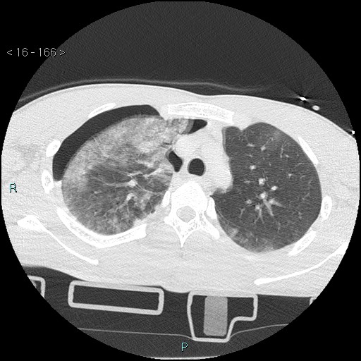 Blunt chest trauma (Swiss cheese sign) (Radiopaedia 38519-40618 Axial lung window 19).jpg
