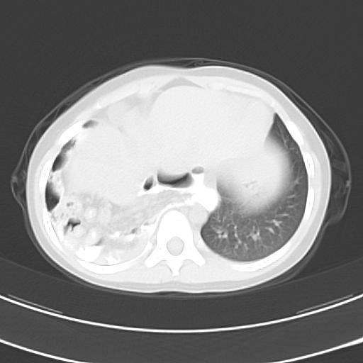 File:Bochdalek diaphragmatic hernia (Radiopaedia 38866-41059 Axial lung window 20).jpg