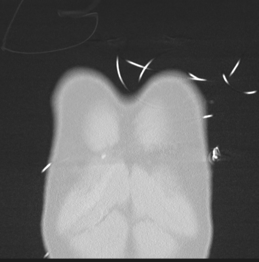 Boerhaave syndrome (Radiopaedia 39382-41661 Coronal lung window 2).png