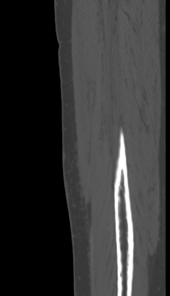 Bone metastasis - tibia (Radiopaedia 57665-64609 Sagittal bone window 152).jpg