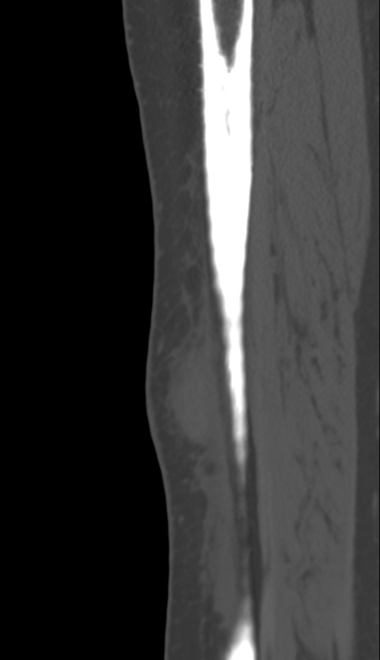 Bone metastasis - tibia (Radiopaedia 57665-64609 Sagittal bone window 39).jpg