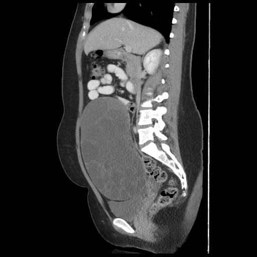 File:Borderline mucinous tumor (ovary) (Radiopaedia 78228-90808 B 31).jpg
