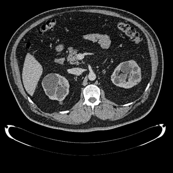 File:Bosniak renal cyst - type IV (Radiopaedia 24244-24518 C 123).jpg