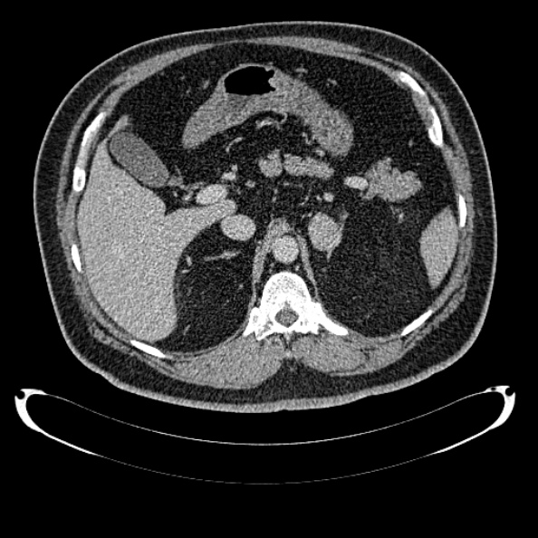 Bosniak renal cyst - type IV (Radiopaedia 24244-24518 C 88).jpg