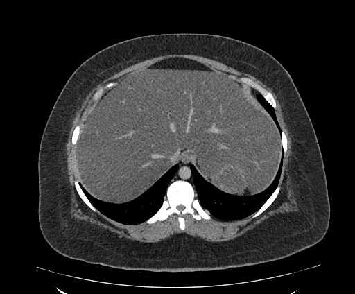 Bowel and splenic infarcts in acute lymphocytic leukemia (Radiopaedia 61055-68913 A 27).jpg