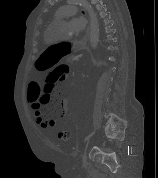 Bowel ischemia secondary to SMA occlusion with extensive portomesenteric venous gas (Radiopaedia 54656-60871 Sagittal bone window 41).jpg