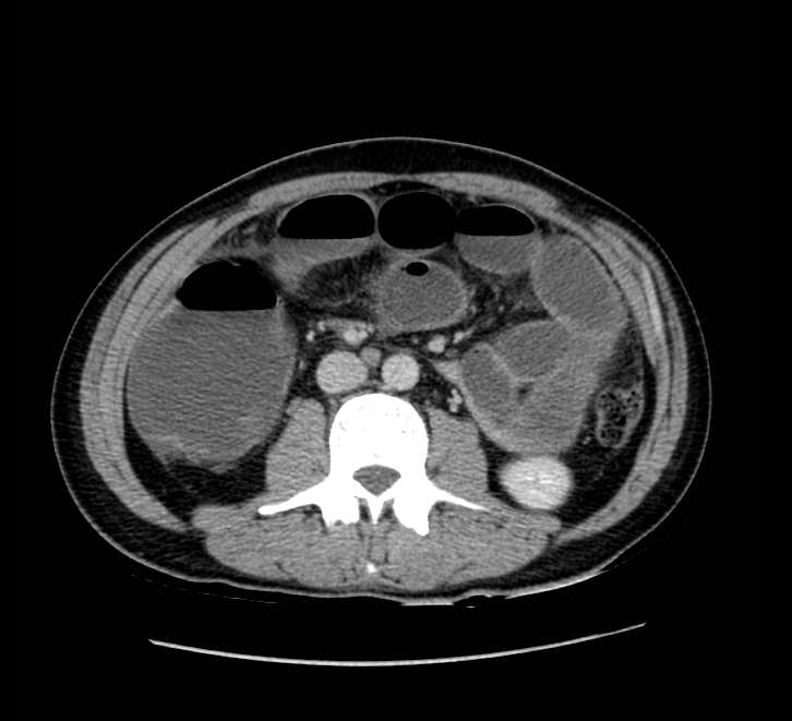Bowel obstruction from colon carcinoma (Radiopaedia 22995-23028 A 42).jpg