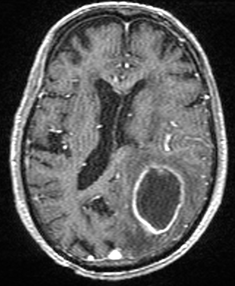 Brain abscess with dual rim sign (Radiopaedia 87566-103938 Axial T1 C+ 97).jpg