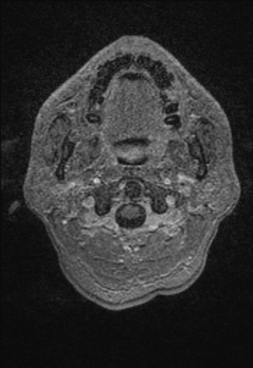 Brain abscess with ventriculitis (Radiopaedia 85703-101495 Axial T1 C+ 4).jpg