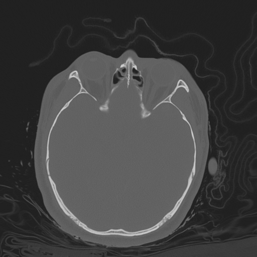 Brain contusions, internal carotid artery dissection and base of skull fracture (Radiopaedia 34089-35339 Axial bone window 68).png