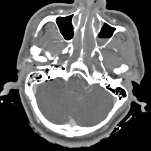 Brain contusions, internal carotid artery dissection and base of skull fracture (Radiopaedia 34089-35339 D 44).png