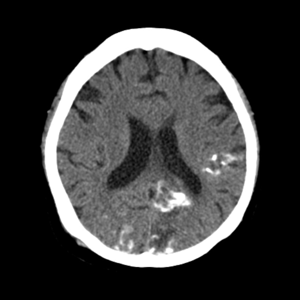 Brain cortical laminar necrosis (Radiopaedia 25822-25971 Axial non-contrast 27).jpg
