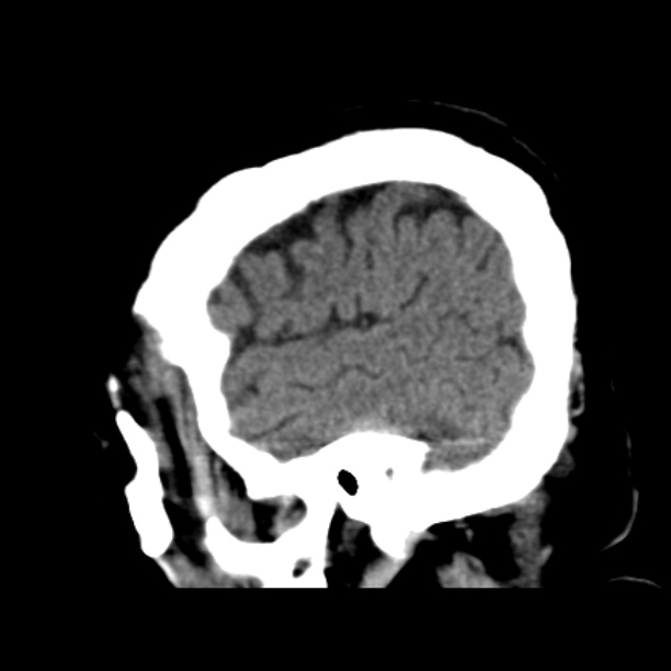 Brain cortical laminar necrosis (Radiopaedia 25822-25971 non-contrast 10).jpg