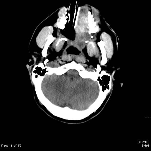 File:Brain death after motor vehicle collision (Radiopaedia 88470-105114 Axial non-contrast 6).jpg