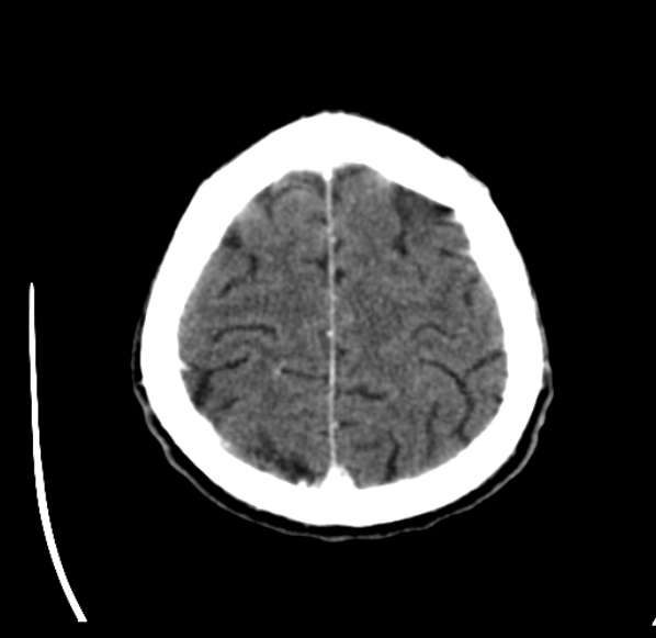 File:Brain metastases from lung cancer (Radiopaedia 24480-24781 Axial C+ delayed 53).jpg