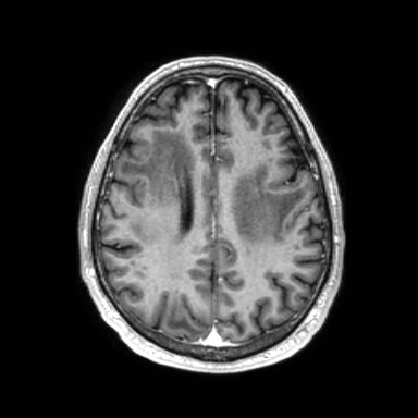 Brain metastases from lung cancer (Radiopaedia 83839-99028 Axial T1 C+ 45).jpg