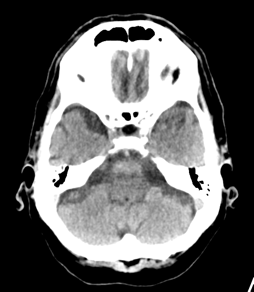 File:Brain metastasis (lung cancer) (Radiopaedia 48289-53177 Axial non-contrast 7).png