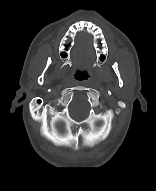 Branchial cleft cyst (Radiopaedia 31167-31875 Axial bone window 15).jpg