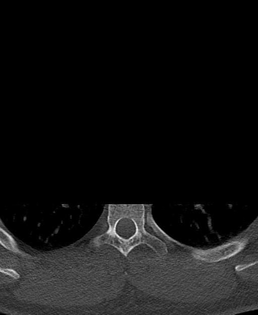 Branchial cleft cyst (Radiopaedia 31167-31875 Axial bone window 91).jpg