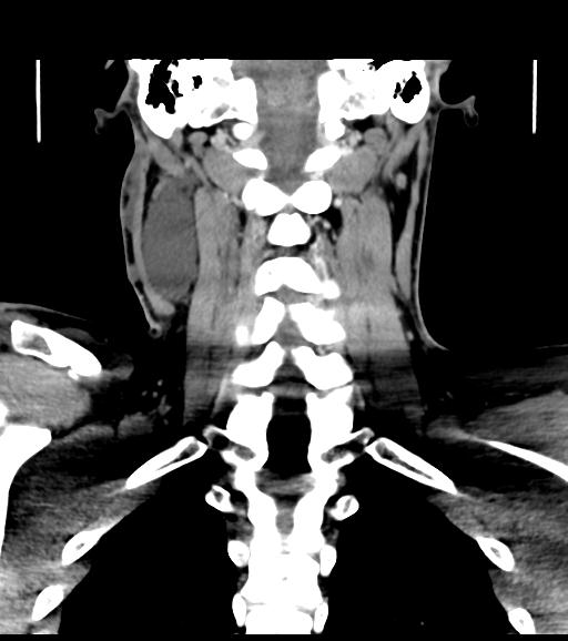 File:Branchial cleft cyst (Radiopaedia 31167-31875 Coronal C+ delayed 45).jpg