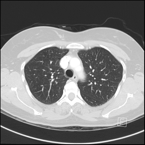 Breast metastases from renal cell cancer (Radiopaedia 79220-92225 Axial lung window 23).jpg