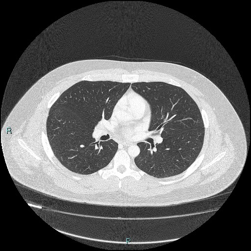 Bronchial carcinoid tumor (Radiopaedia 78272-90875 Axial lung window 24).jpg