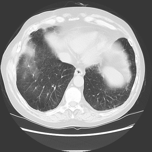 Bronchial stenosis - lung transplant (Radiopaedia 73133-83848 Axial lung window 48).jpg