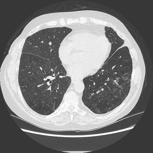 File:Bronchial stenosis - lung transplant (Radiopaedia 73133-83848 B 21).jpg