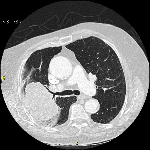 Bronchogenic carcinoma as an incidental finding (Radiopaedia 16453-16130 Axial lung window 73).jpg