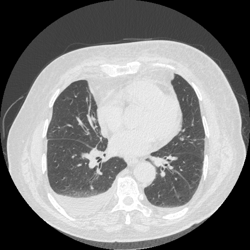 File:Bronchogenic carcinoma with metastatic lymphadenopathy (Radiopaedia 37671-39569 Axial lung window 34).jpg