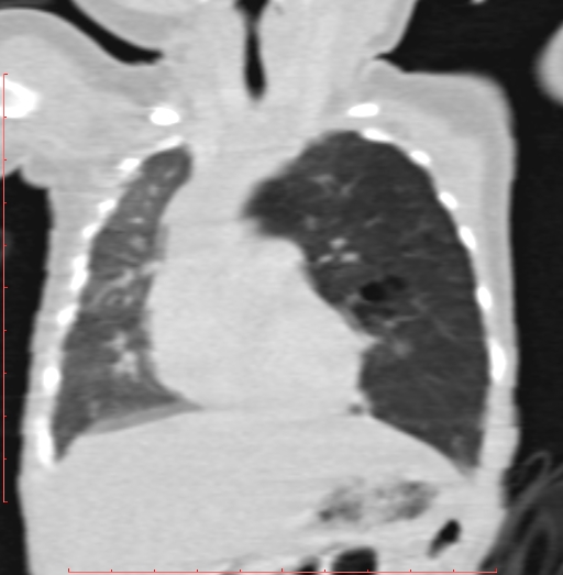 File:Bronchogenic cyst (Radiopaedia 78599-91409 Coronal lung window 89).jpg