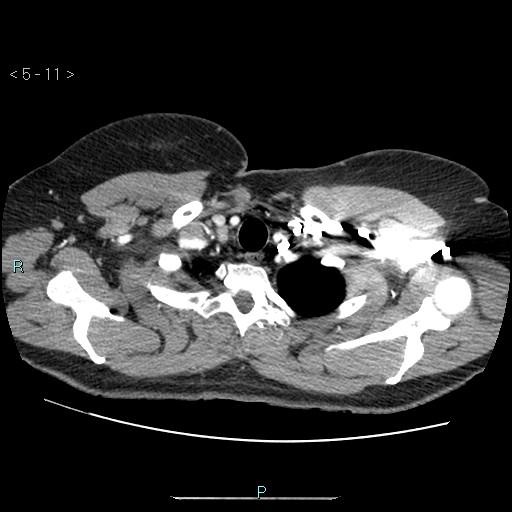Bronchogenic cyst - posterior mediastinal (Radiopaedia 43885-47364 A 6).jpg
