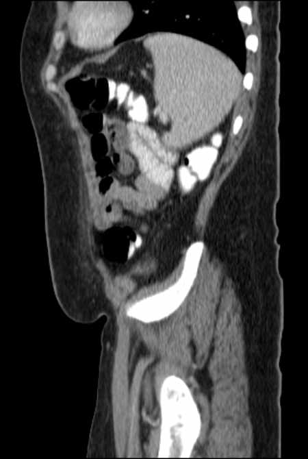 Brown tumors compressing the spinal cord (Radiopaedia 68442-77988 F 46).jpg