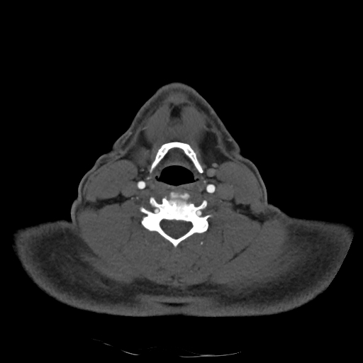 Buccal fat pad arteriovenous malformation (Radiopaedia 70936-81144 A 74).jpg