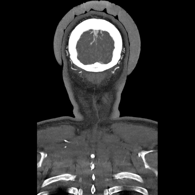 Buccal fat pad arteriovenous malformation (Radiopaedia 70936-81144 B 56).jpg