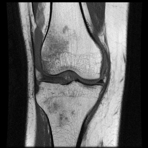 File:Bucket handle meniscus tear (Radiopaedia 56916-63751 Coronal T1 9).jpg